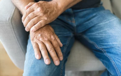 Close-up of hands resting on a knee, illustrating the impact of arthritis and the importance of physical therapy for maintaining independence in aging individuals.