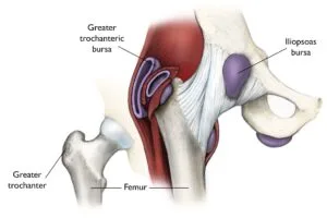 Illustration of the hip anatomy highlighting the greater trochanteric bursa and iliopsoas bursa, relevant to trochanteric bursitis and hip pain management.