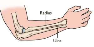 Diagram of the radius and ulna bones in the forearm, illustrating anatomical structure relevant to wrist and forearm fractures.