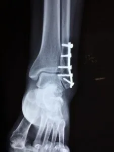 X-ray image of an ankle showing surgical hardware, indicating treatment for a severe ankle sprain or fracture, relevant to discussions on ankle instability and rehabilitation options.