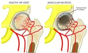 Illustration comparing healthy hip joint and avascular necrosis, highlighting blood supply disruption and femoral head collapse.