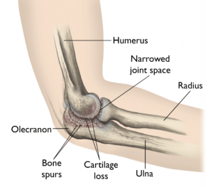 Illustration of elbow anatomy highlighting conditions related to osteoarthritis, including labeled features such as humerus, radius, ulna, olecranon, bone spurs, cartilage loss, and narrowed joint space.