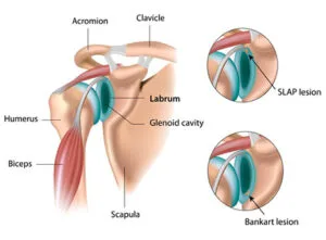 Illustration of shoulder anatomy highlighting the labrum, glenoid cavity, and associated lesions, including SLAP and Bankart lesions, relevant to labral tears and shoulder health.