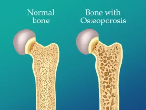 Illustration comparing normal bone structure to bone affected by osteoporosis, highlighting differences in density and fragility.